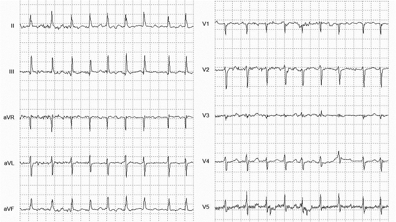 Atrial Fibrillation 12 Lead EKG_fig2